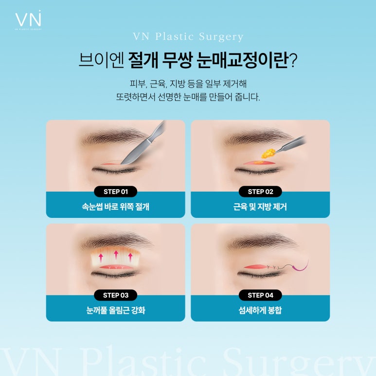 남자눈성형, 여자눈성형과는 어떤 차이점이 있나요? 관련 이미지 6