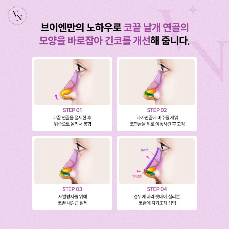 VN Plastic Surgery, Worried About a Long Midface? image 5