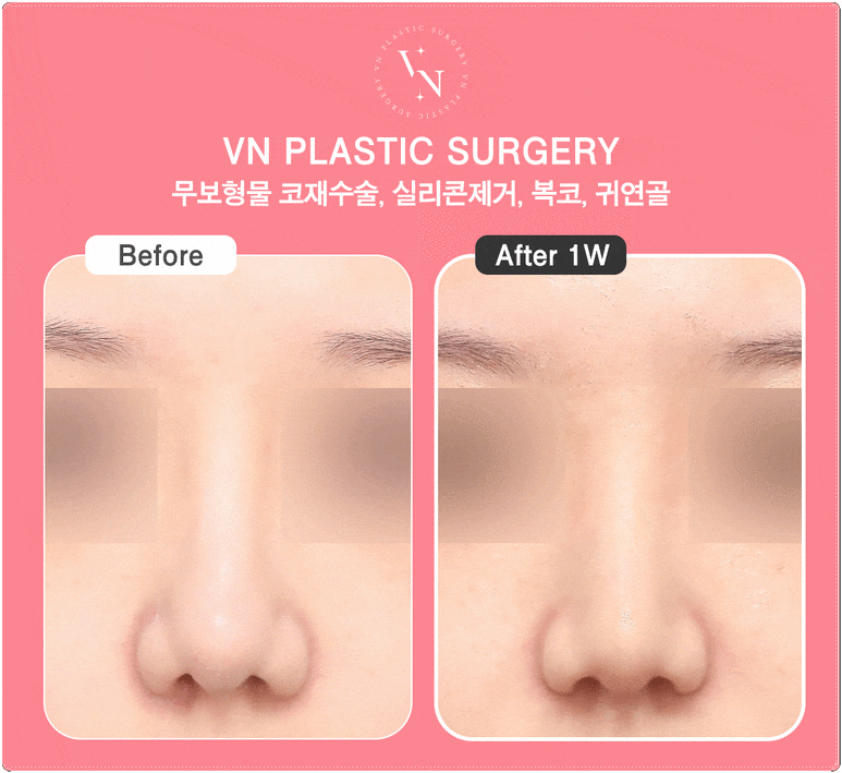 Why the Tip of the Nose Looks Blunt and Large: VN Plastic Surgery’s Bulbous Nose Surgery image 7