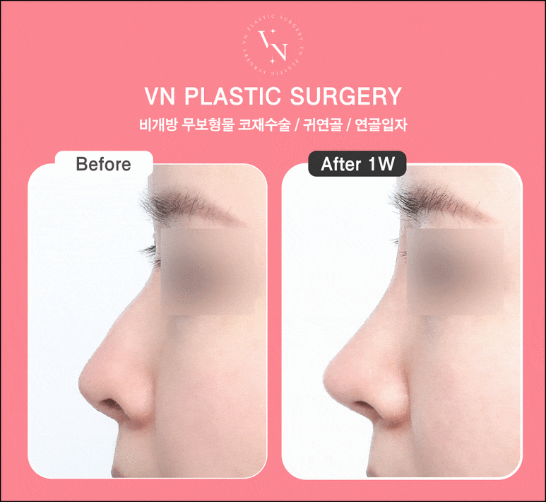VN Plastic Surgery: When Closed Revision Rhinoplasty Is Possible (Side Effects / Contour / Nasal Tip) image 3
