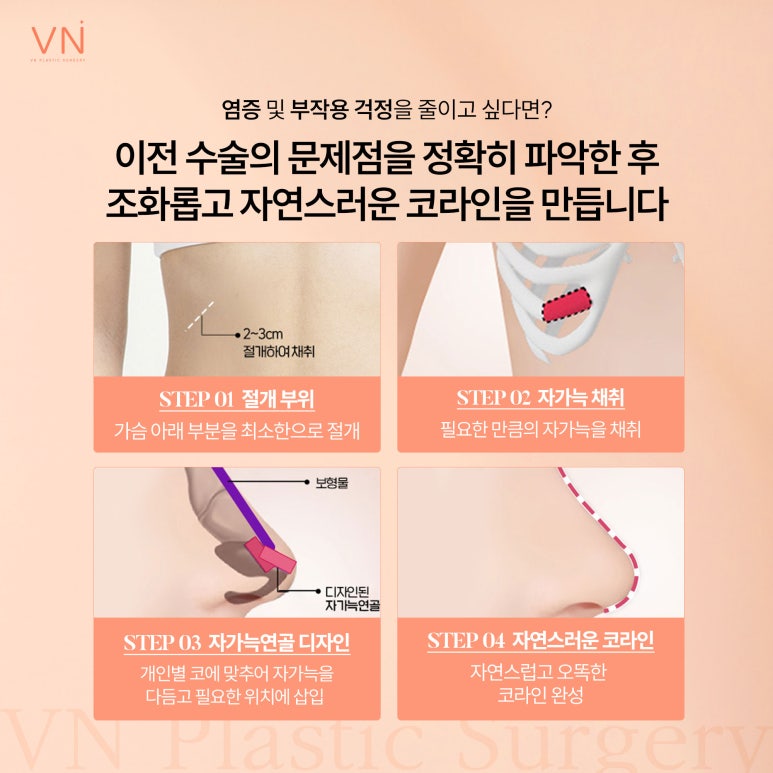 코재수술 시 어떤 재료로 수술해야 할까요? (ft. 미니자가늑코재수술) 관련 이미지 5