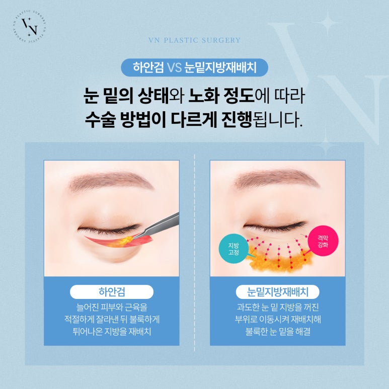 VN Plastic Surgery: What Are the Differences Between Lower Blepharoplasty and Under-Eye Fat Repositioning? image 4