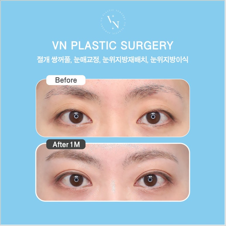 Double Eyelid Incision Surgery Review｜Do I Need Incisional Double Eyelid Surgery? image 3