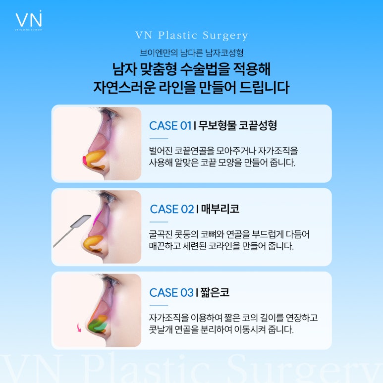 남자코성형, 여자와 다른 디자인과 맞춤형 접근 필요 관련 이미지 3