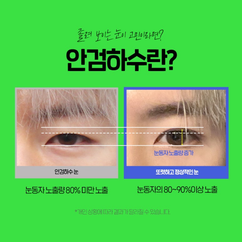 부담스럽지 않게 잘생겨지는 방법은? 브이엔성형외과 남자속쌍꺼풀성형 알아보기! 관련 이미지 5