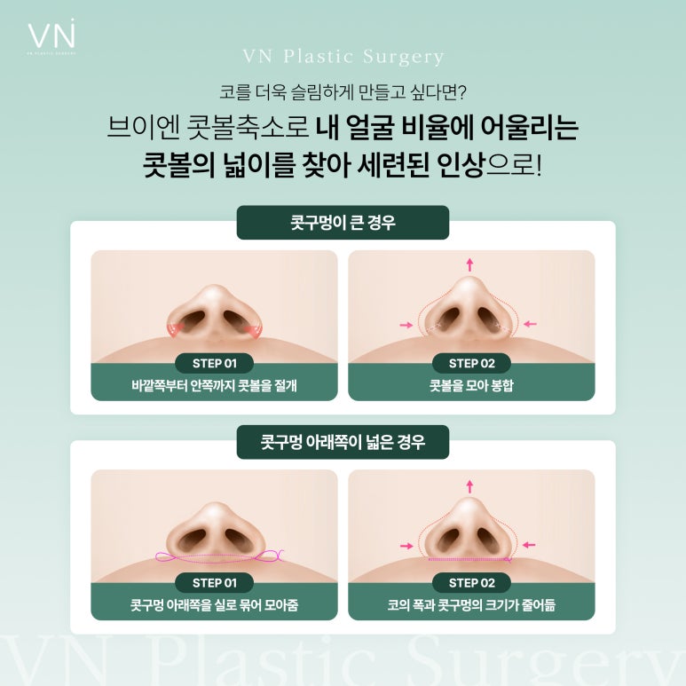 복코 수술, 일반적인 코수술과는 어떤 차이가 있을까? 관련 이미지 4