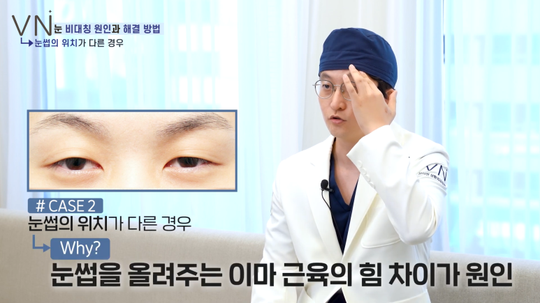 첫쌍꺼풀수술 전, 비대칭 짝눈의 원인과 해결법을 알아보자! 😀 관련 이미지 5
