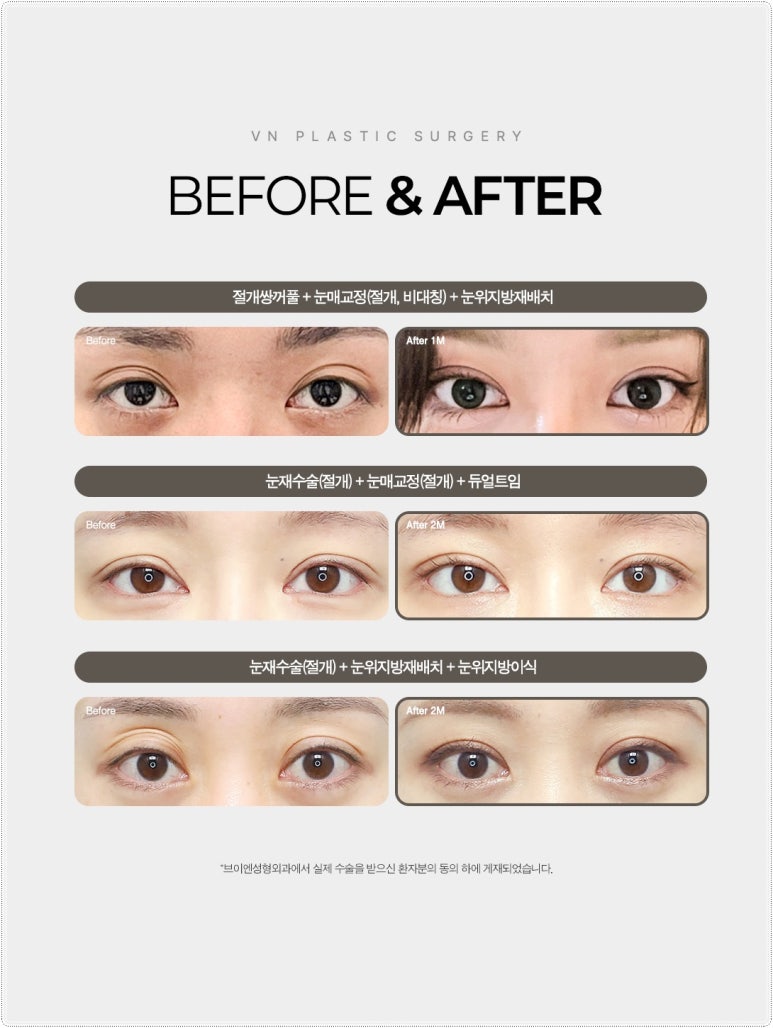 Why Extreme Eye Revision Surgery Is Difficult for Hooded Eyes, Asymmetric Eyes, and Double Fold Correction [VN Plastic Surgery, Gangnam] image 10