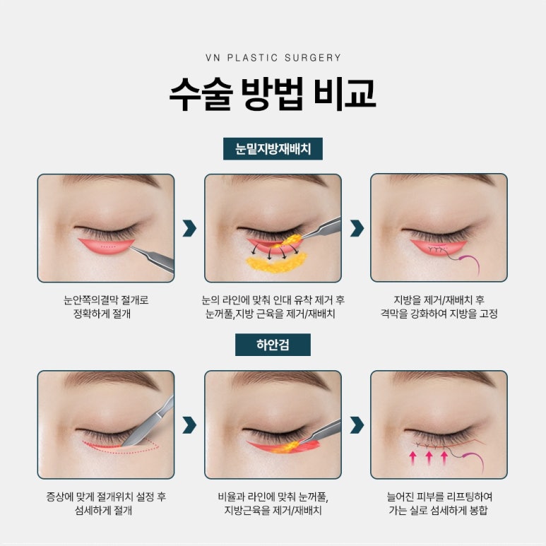 VN Plastic Surgery Lower Blepharoplasty vs. Lower Eyelid Fat Repositioning: Which Is Right for Me? image 3