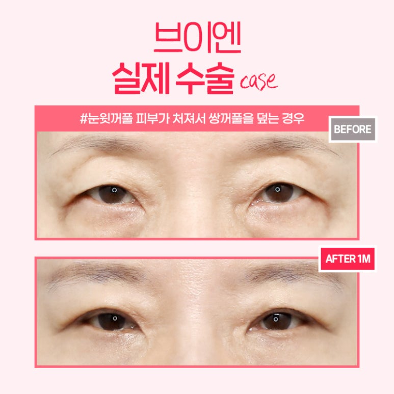 대표적인 중년눈성형 알아보기 I 브이엔성형외과 관련 이미지 2