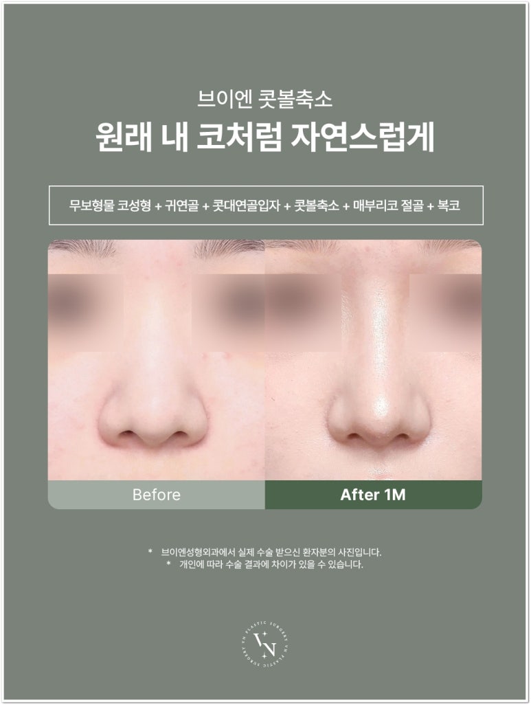 콧볼축소수술 많이 줄이면 어떻게 될까? 상담 전 알아둘 점 관련 이미지 3