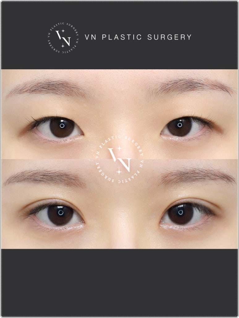 VN Plastic Surgery: If the Inline Looked Too Constricted and the Outline Felt Too Dramatic image 6