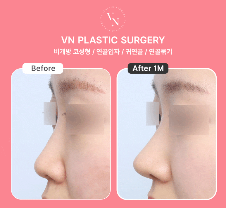 Thinking About Non-Open Nose Surgery? Find the Answer with ShashaKo at VN Plastic Surgery image 4