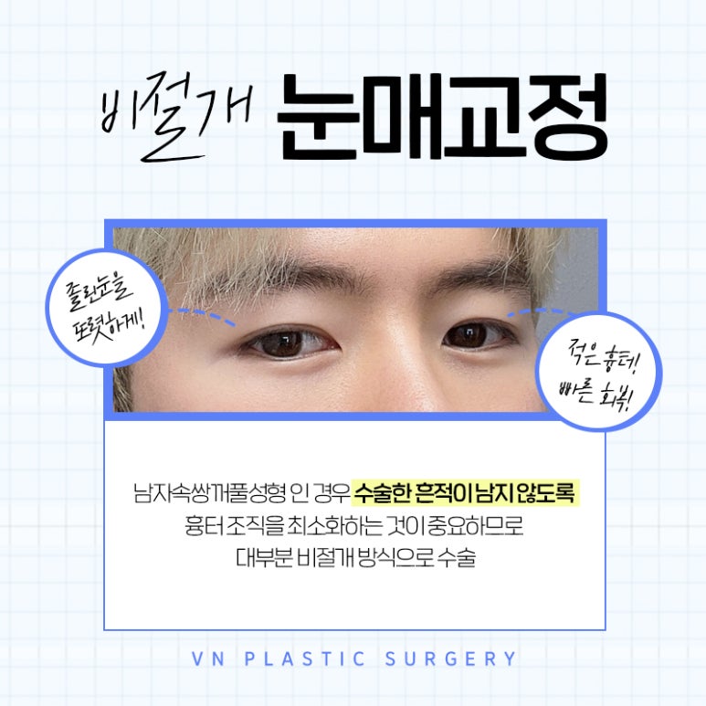 부담스럽지 않게 잘생겨지는 방법은? 브이엔성형외과 남자속쌍꺼풀성형 알아보기! 관련 이미지 6