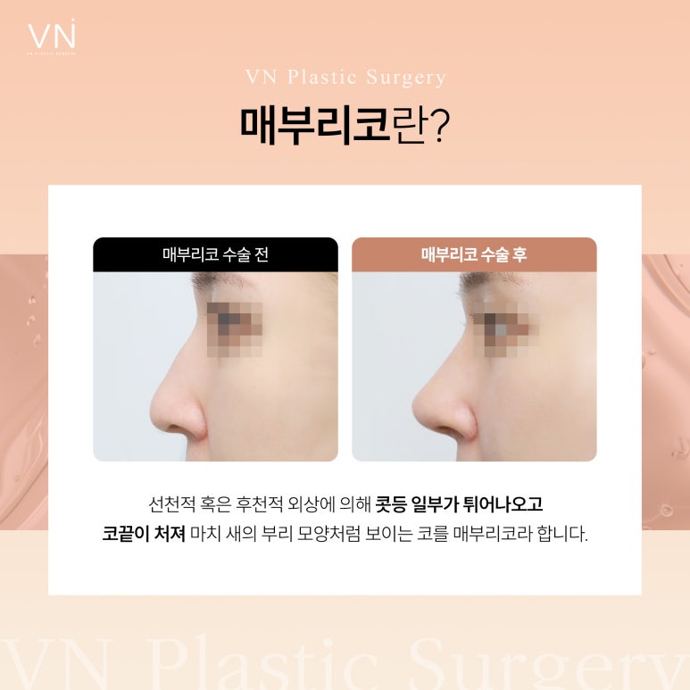 The Importance of Personalized Surgery for Hump Nose Surgery image 2