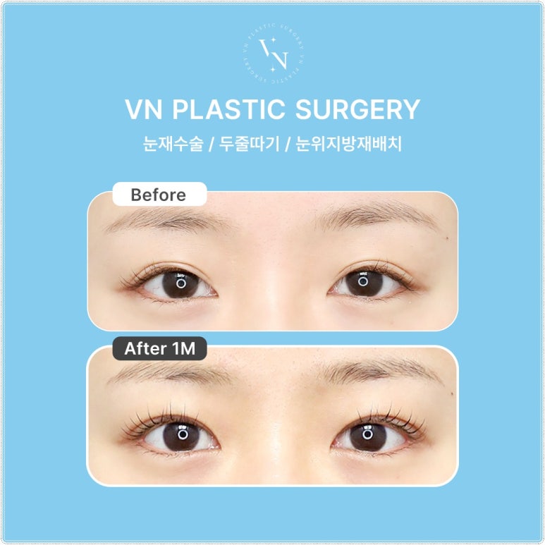 Why Extreme Eye Revision Surgery Is Difficult for Hooded Eyes, Asymmetric Eyes, and Double Fold Correction [VN Plastic Surgery, Gangnam] image 4