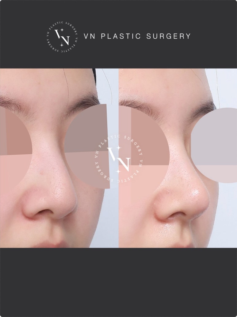 Nose Surgery Without Implants: The Shashaco Principle Using Autologous Cartilage and Real Cases image 2