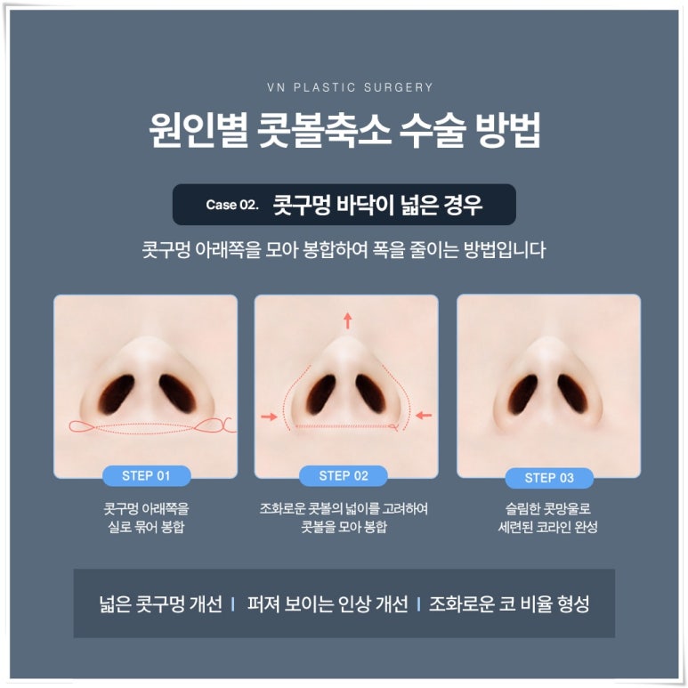Concerned About Wide Nostrils? What to Know Before Consulting About Alar Reduction | 브이엔성형외과 image 4