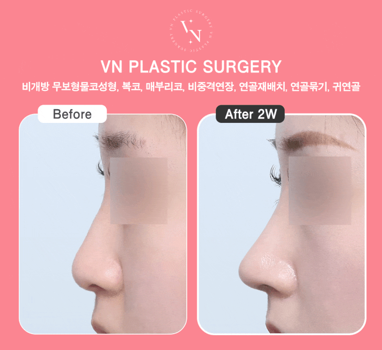 무보형물코성형으로 완성하는 자연스러운 변화, 강남역 성형외과 선택 노하우 관련 이미지 8