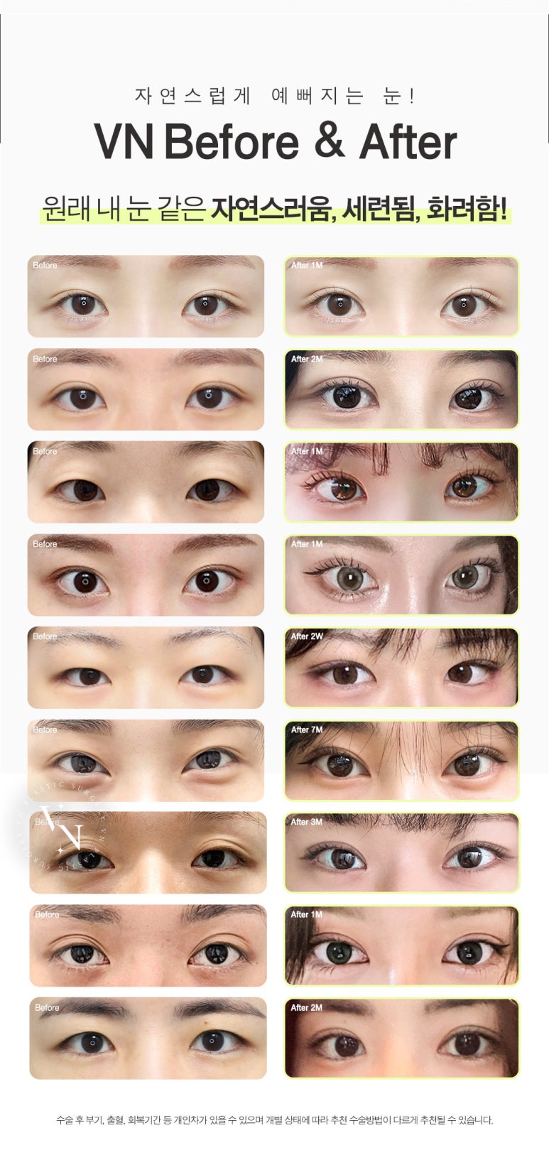 수험생만을 위한 특별한 눈성형 혜택, [브이엔성형외과, 수능눈성형] 관련 이미지 7