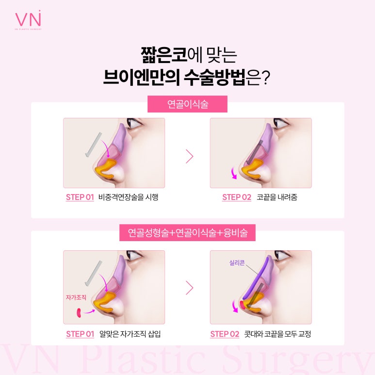유형별로 알아보는 코수술, 나는 어떤 유형일까? 관련 이미지 6