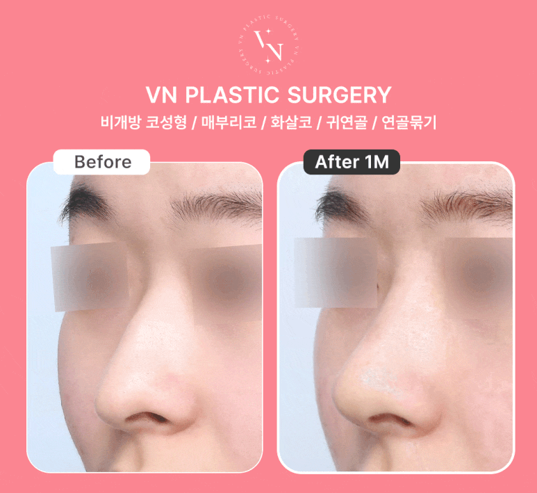 [Arrow Nose Correction in Sinnonhyeon/Gangnam] How to Fix a Nose That Looks Long and Change Your Impression ｜ VN Plastic Surgery image 7
