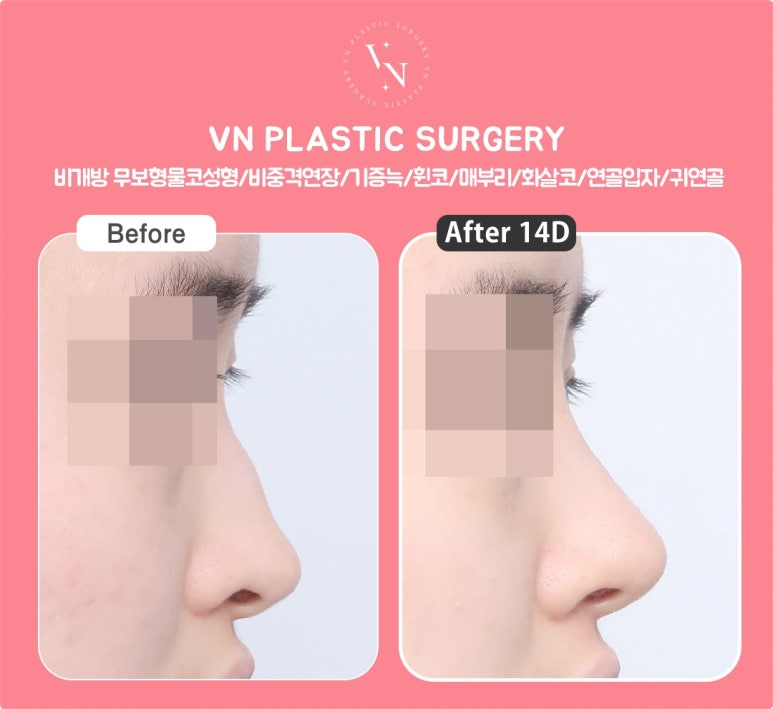Why Does the Cost of Hump Nose Surgery Vary by Clinic? 5 Reasons for the Price Difference image 4