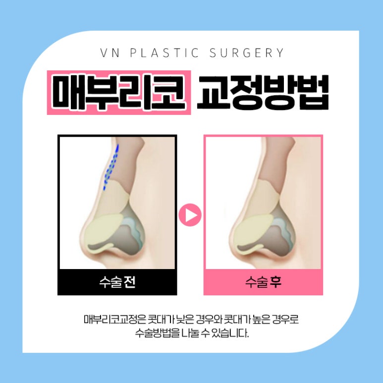 브이엔성형외과 제공｜매부리코교정 방법은? 관련 이미지 4