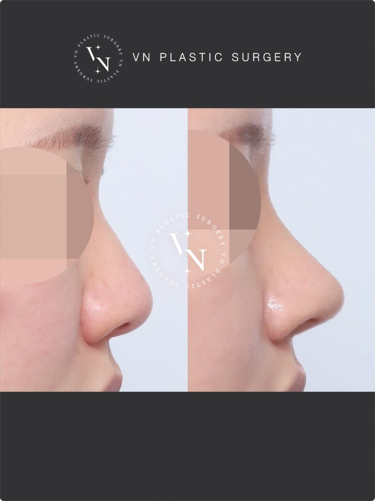 Nose Surgery Without Implants: The Shashaco Principle Using Autologous Cartilage and Real Cases image 3