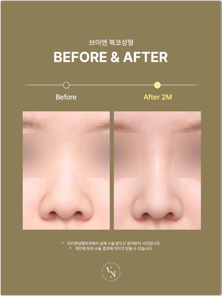 Why the Tip of the Nose Looks Blunt and Large: VN Plastic Surgery’s Bulbous Nose Surgery image 3