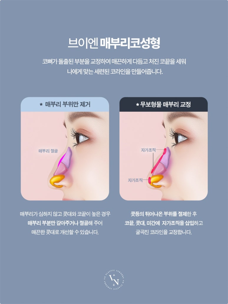 Why Does the Cost of Hump Nose Surgery Vary by Clinic? 5 Reasons for the Price Difference image 2