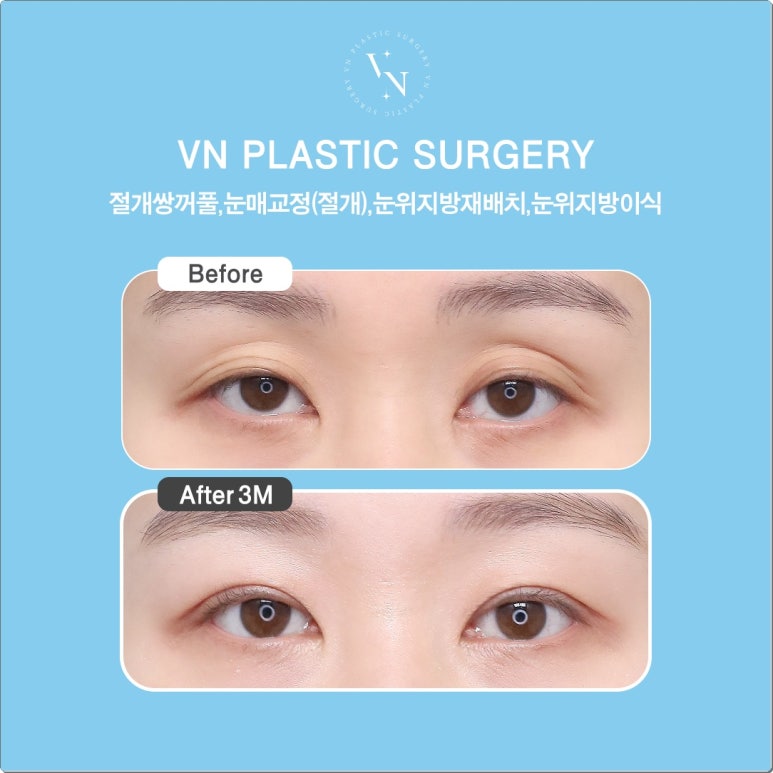 Double-Line Revision: How to Lower a High Double-Eyelid Crease | VN Plastic Surgery image 6