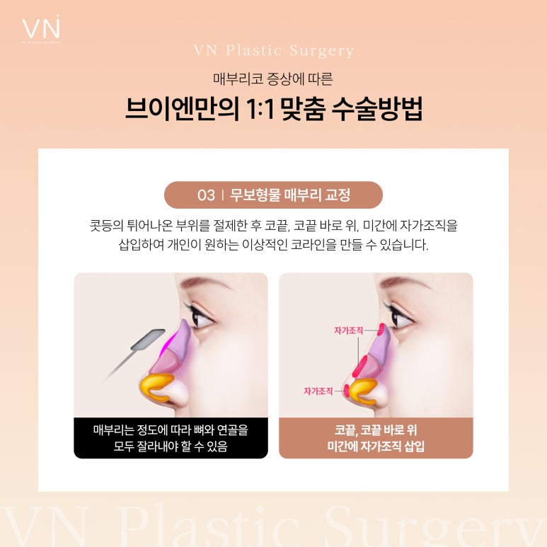 The Importance of Personalized Surgery for Hump Nose Surgery image 5