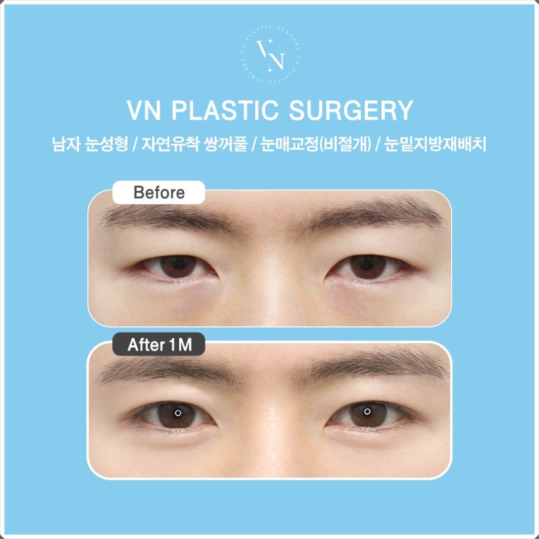 Male Eye Surgery: The Difference in Details That Create a Natural Eye Shape image 6
