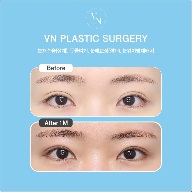 Double-Line Revision: How to Lower a High Double-Eyelid Crease | VN Plastic Surgery image 5