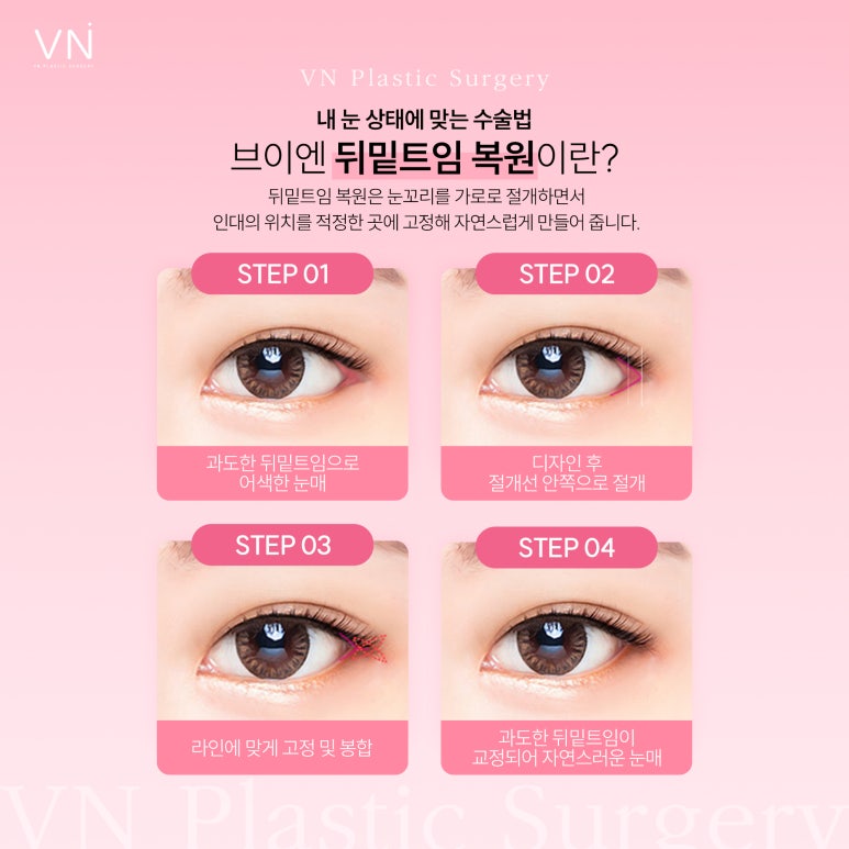 Correction of canthoplasty, when can it be done? image 5