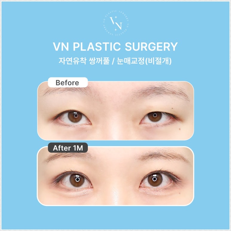 How Eyelid Correction Changes the Eyes: Comparison of Incision and Non-Incision Methods and Recovery Time image 5