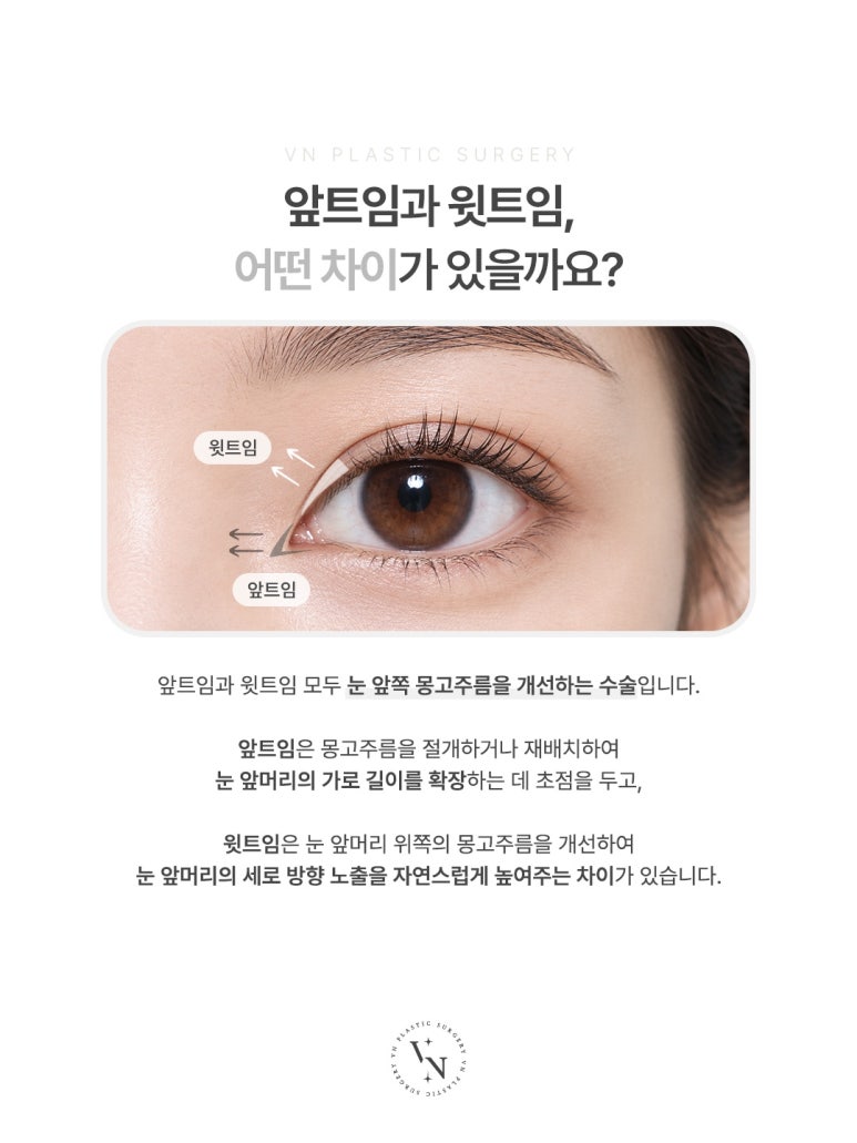 앞트임 윗트임 차이, 같은 트임성형인데 뭐가 다를까? 관련 이미지 2