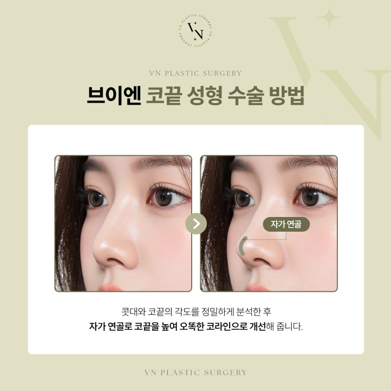 코끝만 성형할 수 있을까? 관련 이미지 5