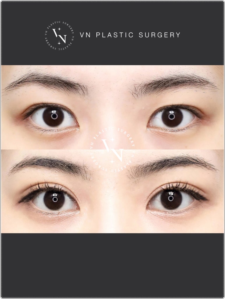 VN Plastic Surgery: If the Inline Looked Too Constricted and the Outline Felt Too Dramatic image 7