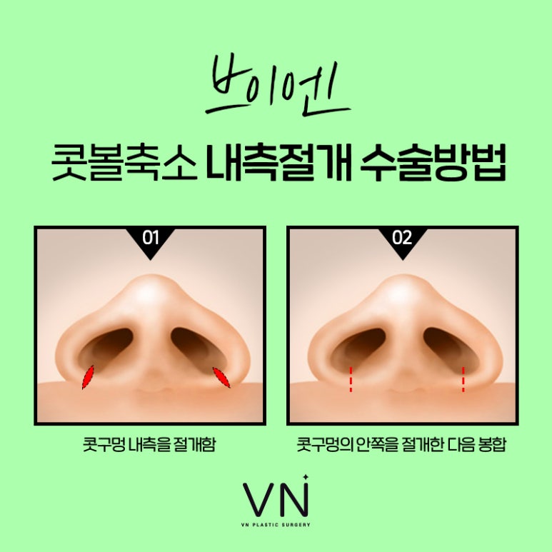 Let’s Get Rid of the Bulbous Nose! Learn About Nostril Reduction Surgery image 4