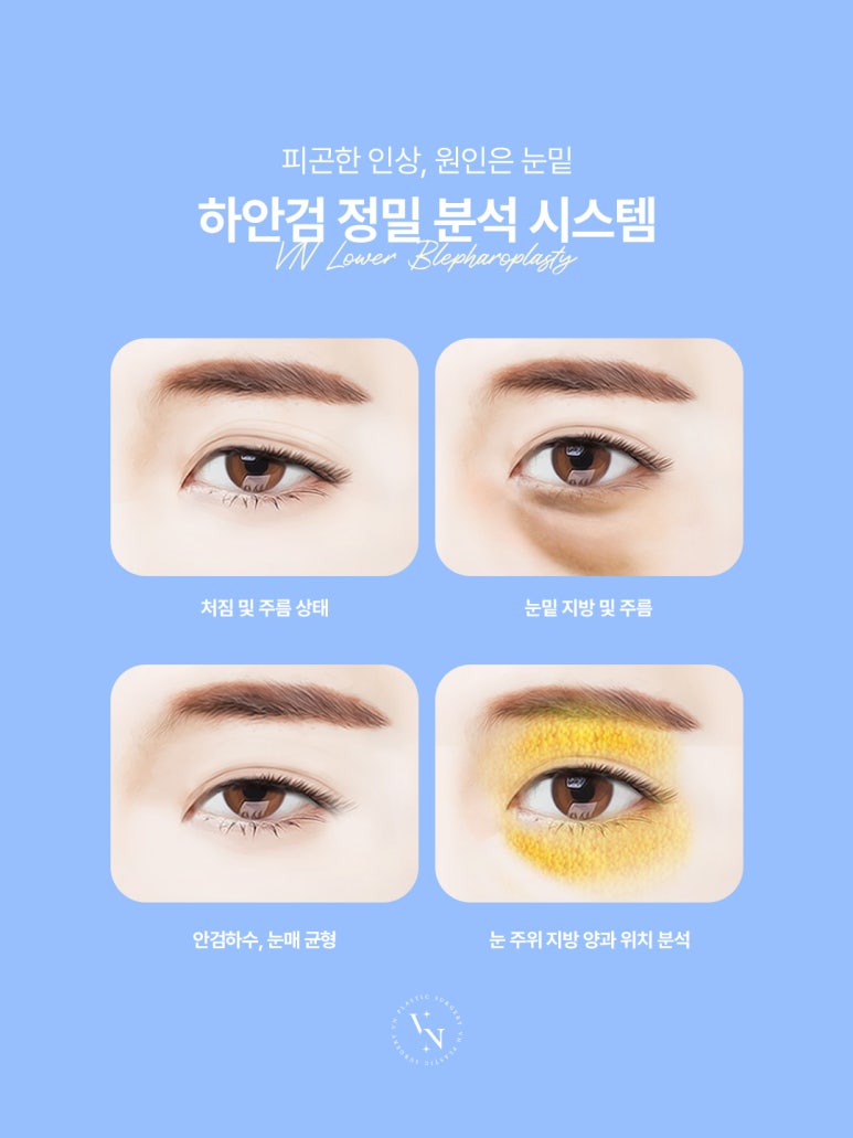 눈밑 처짐을 개선하는 신논현 브이엔성형외과 하안검수술 관련 이미지 2