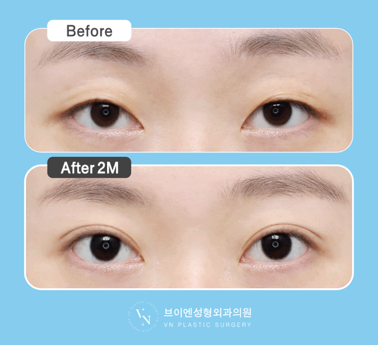 [Sinnonhyeon Plastic Surgery] Before Your First Double Eyelid Surgery, Be Sure to Check This! Do I Have Sunken Eyes or Protruding Eyes? image 4