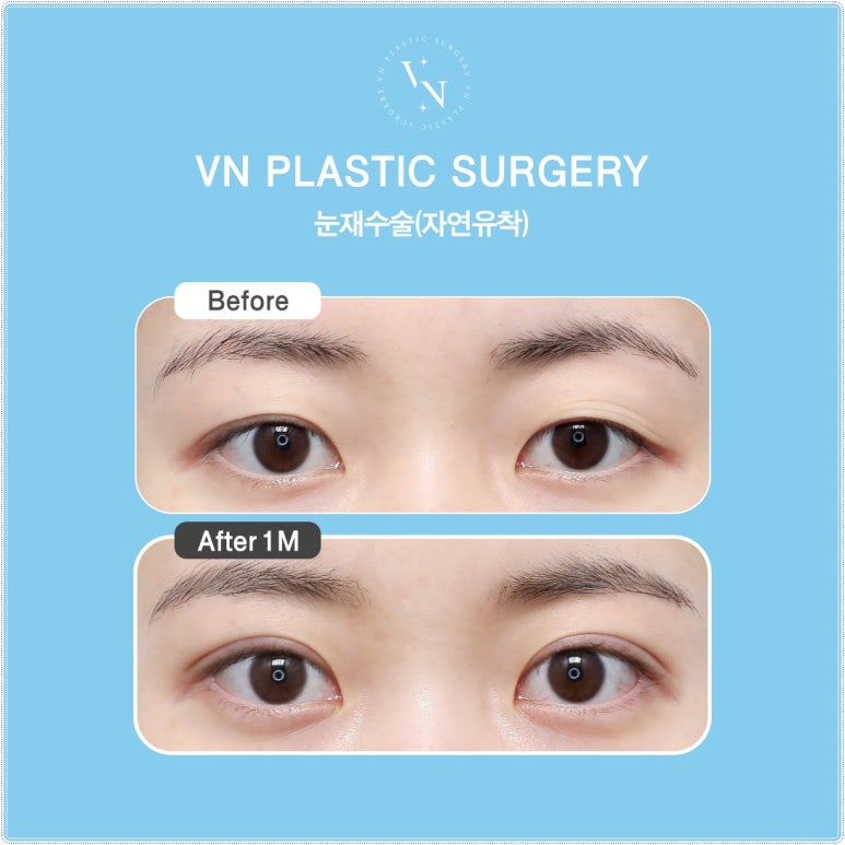 Why Extreme Eye Revision Surgery Is Difficult for Hooded Eyes, Asymmetric Eyes, and Double Fold Correction [VN Plastic Surgery, Gangnam] image 5