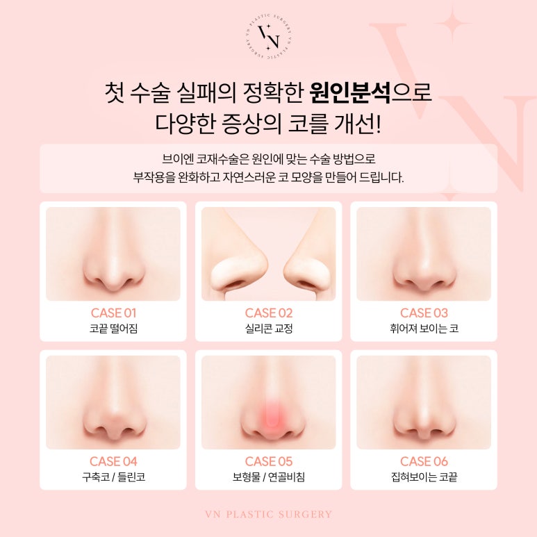 첫코수술보다 코재수술이 어려운 이유는 무엇인가요? 관련 이미지 2