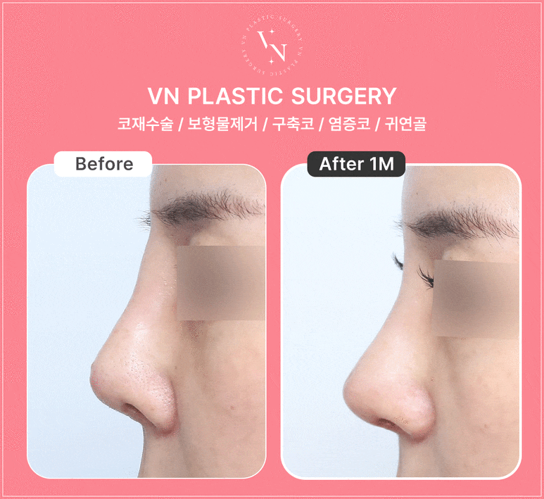 When Should Contracture Nose Revision Surgery Be Done? From Causes to Solutions (VN Plastic Surgery) image 6