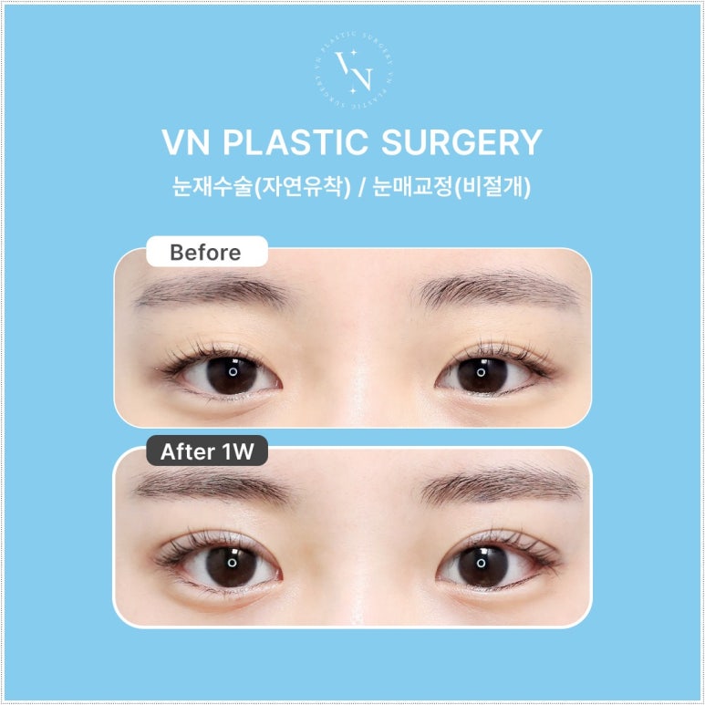 How Eyelid Correction Changes the Eyes: Comparison of Incision and Non-Incision Methods and Recovery Time image 7