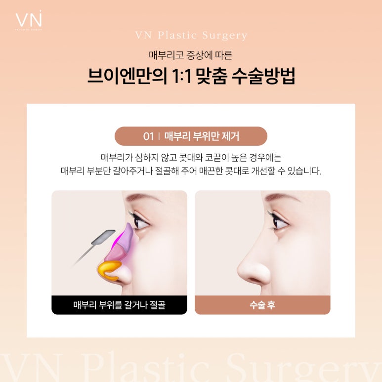 The Importance of Personalized Surgery for Hump Nose Surgery image 3