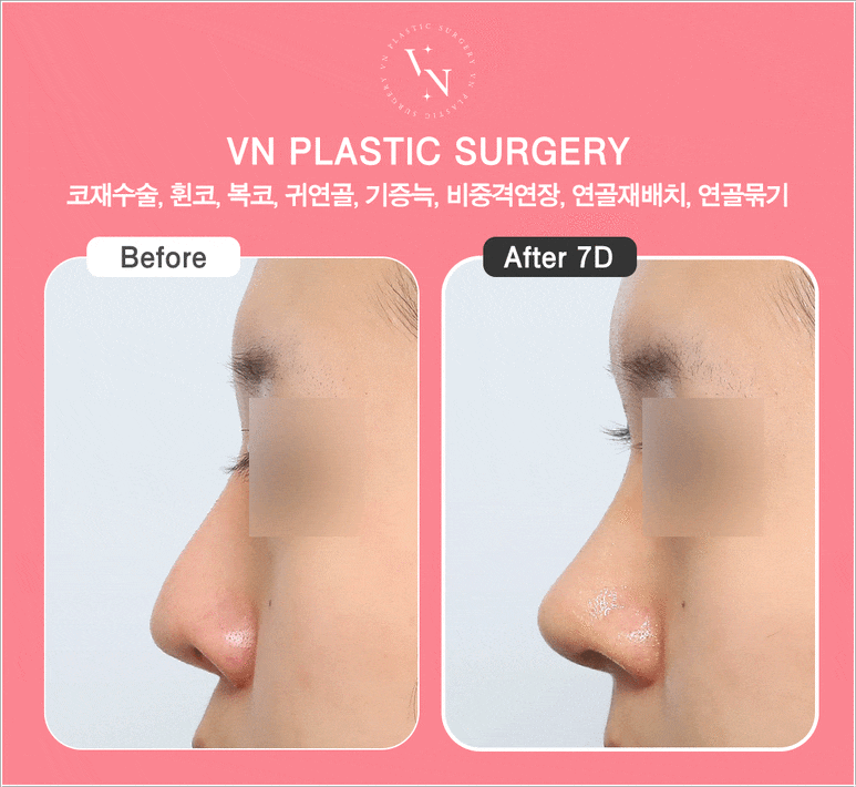 [코재수술잘하는곳] 원하는 코로 다시 바꿀 수 있을까? 관련 이미지 4