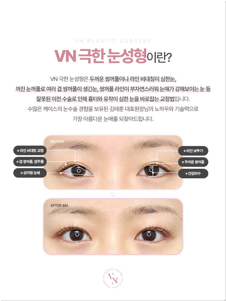 소세지눈 재수술, 아직 기다려야 할까? 붓기와 구분하는 방법 관련 이미지 6